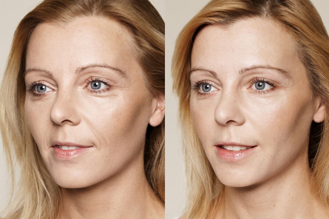 The experience of use before and after using the intenskin cream by Valeria